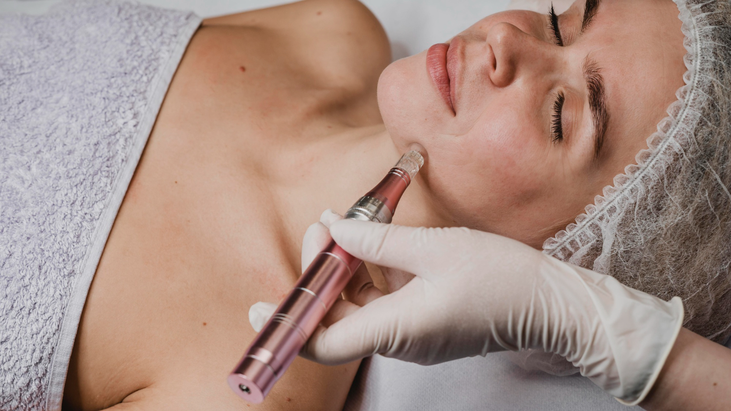 Microneedling-behandling med PDRN